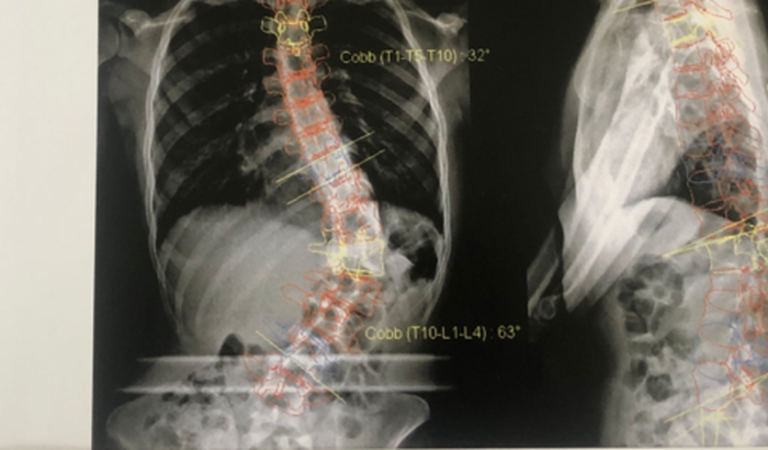 Ajude o Luís Eduardo a conseguir sua cirurgia de escoliose