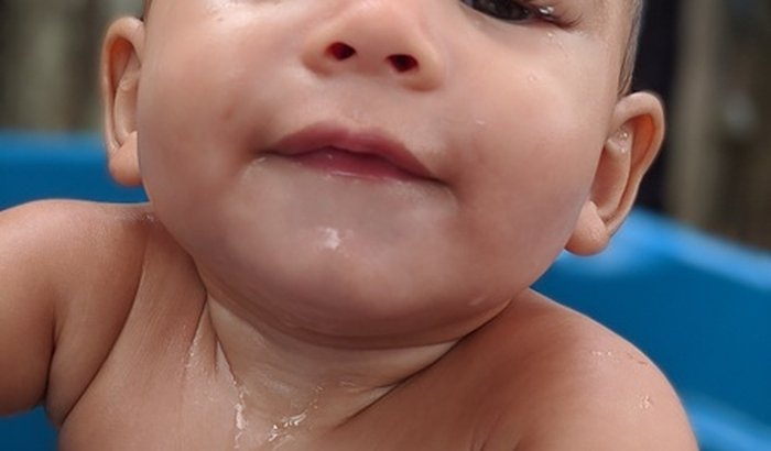 Cirurgia de Ptose Palpebral