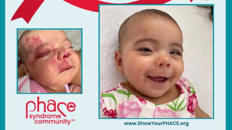 imagem da vaquinha Ajude a Helena no tratamento da Síndrome PHACE