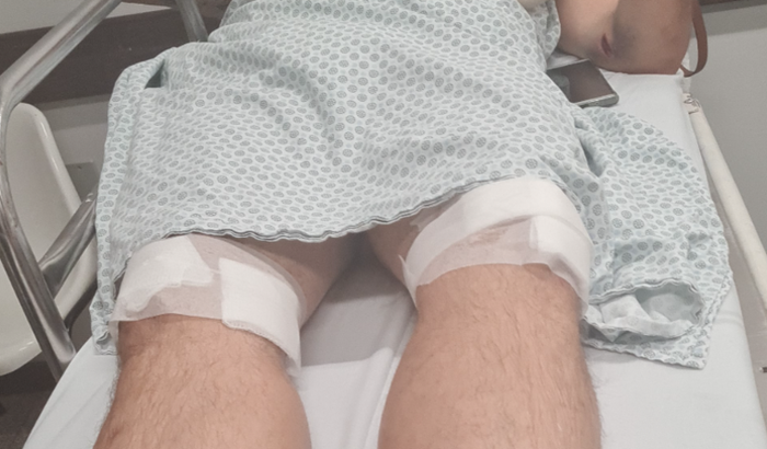 Cirurgia joelho - acidente de moto