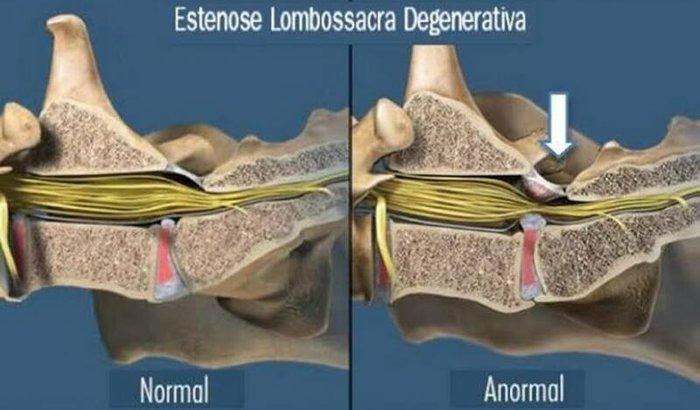 Cirurgia de emergência na coluna vertebral 