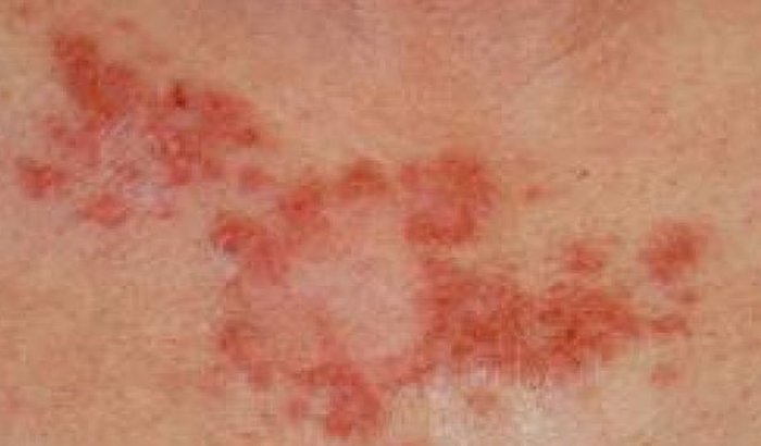 Tratamento do câncer de melanoma, pequeno Gustavo