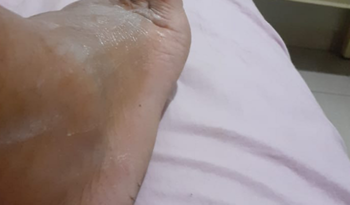 Ajuda para cirurgia no tornozelo trincado