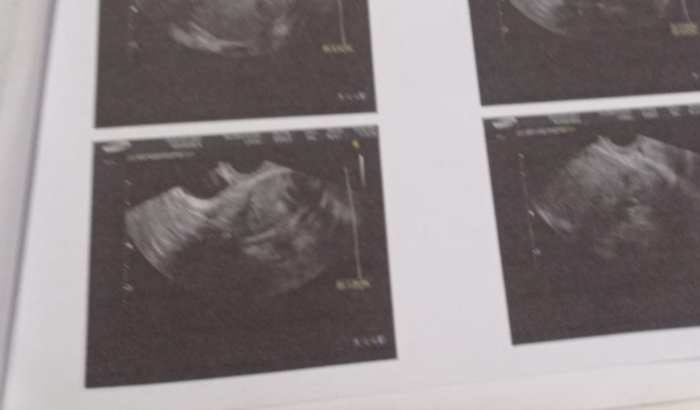 varizes no útero muito grave