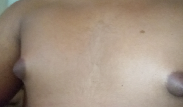 Cirurgia GINECOMASTIA (Pedra no Peito)