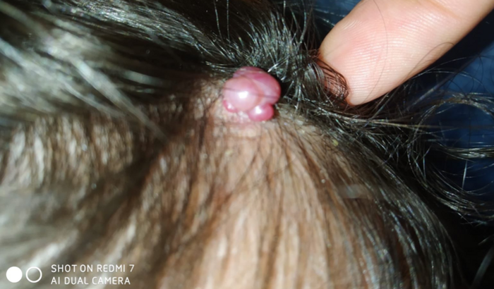 Ajuda para retirar granuloma piogênico