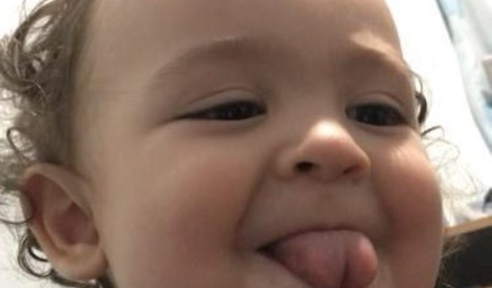 Cirurgia do Gael - Frenectomia