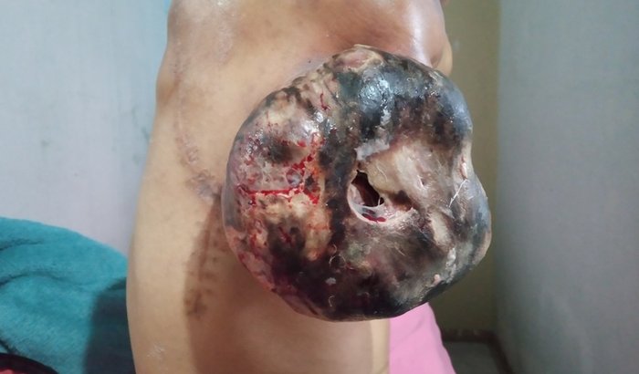 Lutando contra um sarcoma de partes moles com metastase 