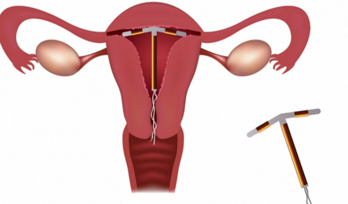 Instrumental e equipamentos para inserção de DIU