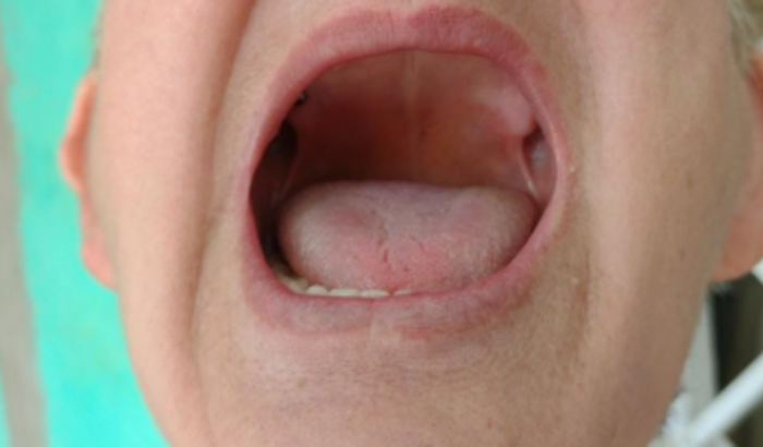 Implante dentário minha mãe