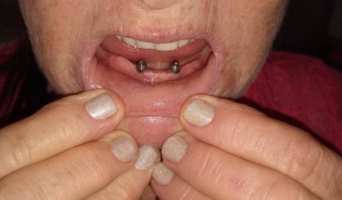 Ajuda  com medicamentos e prótese dentaria.