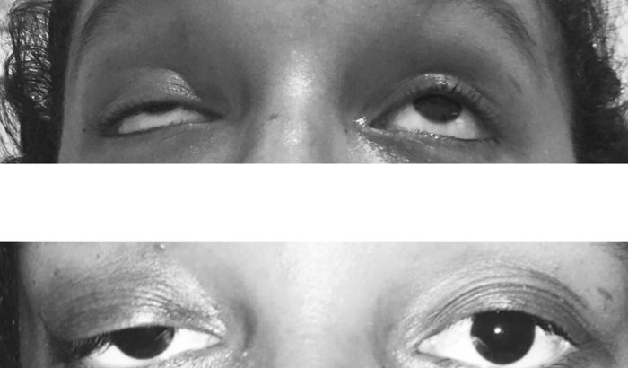 Sonho de Cirurgia de Ptose Palpebral