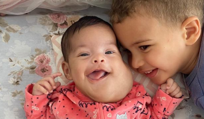 Tratamento Urgente linfangioma Gabriela