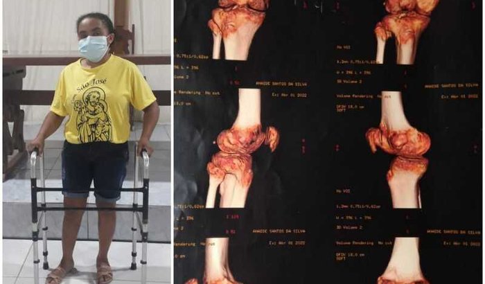 Ajuda pra cirurgia e prótese em 1 joelho