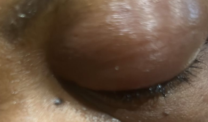 Descolamento de retina grave