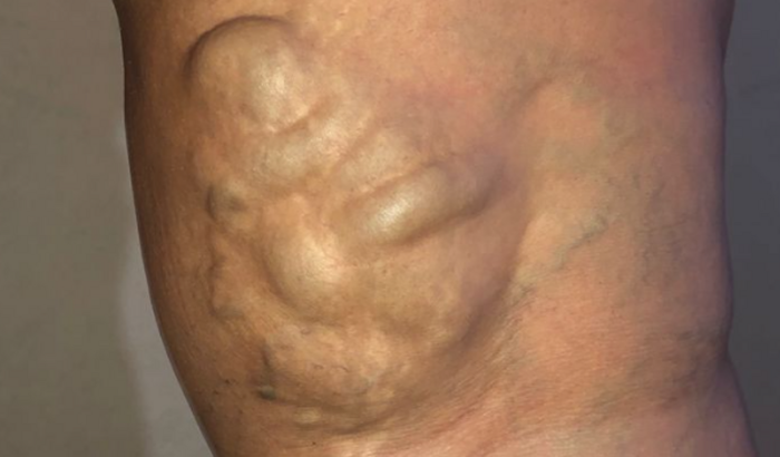 Cirurgia Vascular 