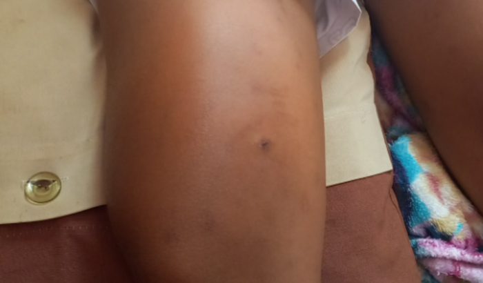 Tratamento Tumor Yago