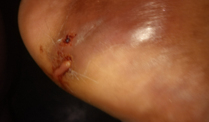 Infecção pé esquerdo...ferimento