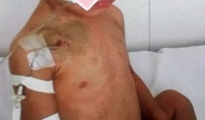 Ajuda para a cirurgia de medula óssea do Ruan