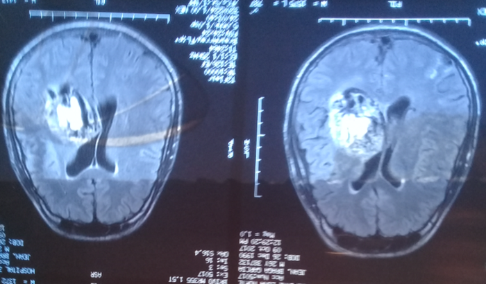 Cirurgia na Cabeça - duas MAV