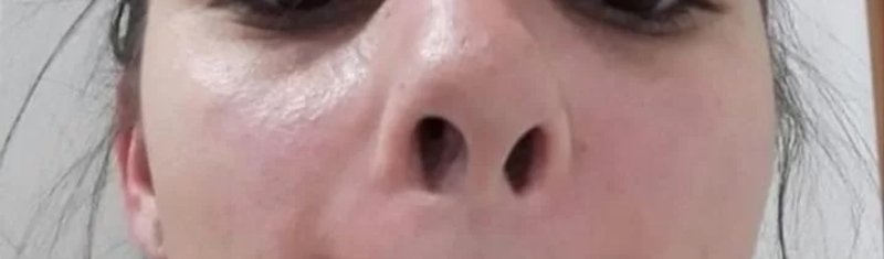 AJUDEM O LUCAS A REFAZER O NARIZ QUEBRADO EM UM ACIDENTE