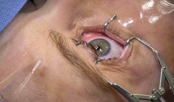 Cirurgia Oftalmológica