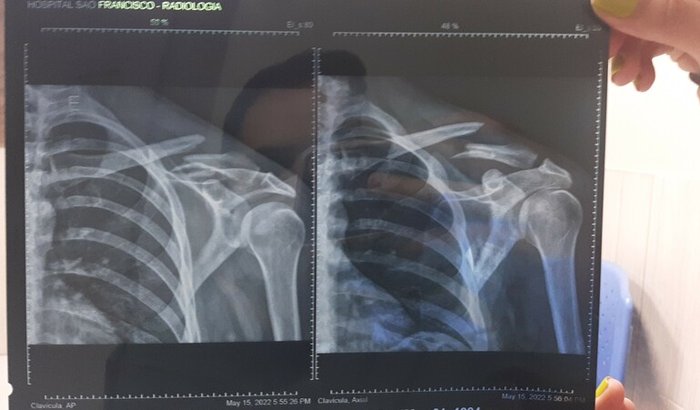Cirurgia do Sayão