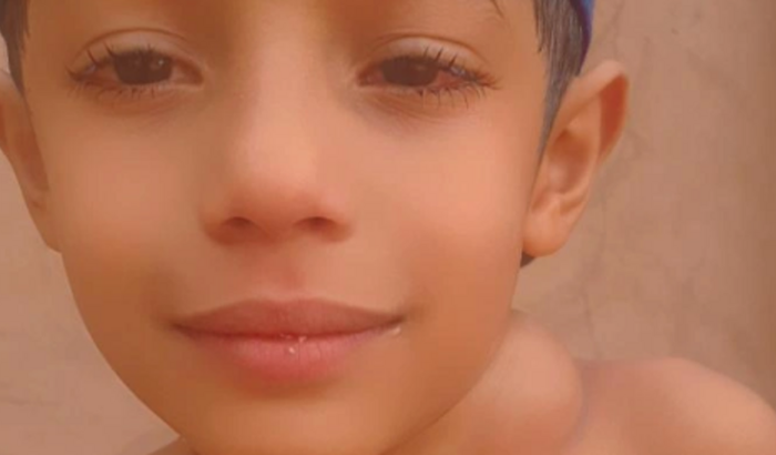 Ajude a cirurgia de remoção de higroma cistico cervical do victor