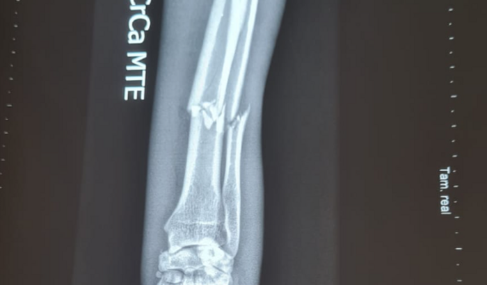 Cirurgia Kiara