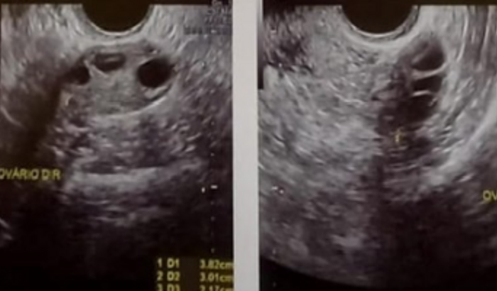 Ajuda para cirurgia retirada útero 