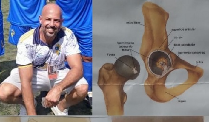 CIRURGIA DE QUADRIL + PRÓTESE URGENTE