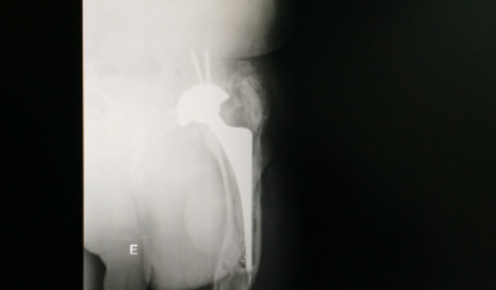 Ajuda a cirurgia  de troca de prótese e fisioterapia pós cirur.