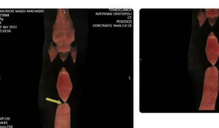 Mauricio Mazui Cirurgia Estenose Traqueal