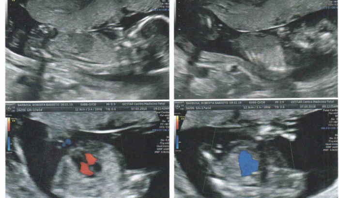 Theo vencendo a Mielo - Cirurgia intrauterina