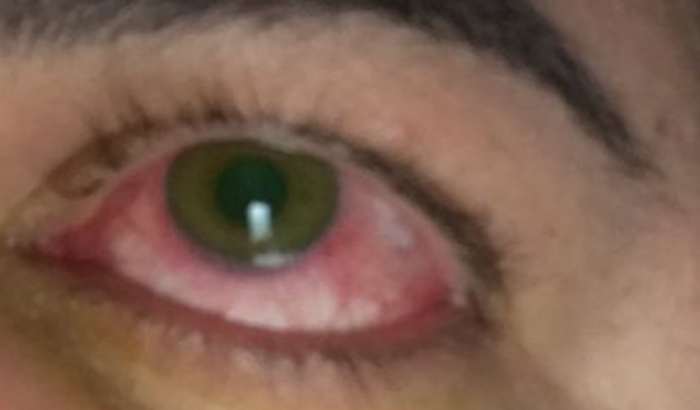 Lentes escleral 