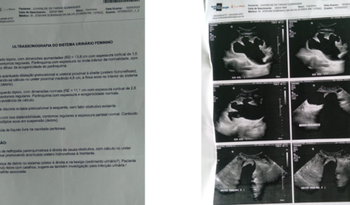 Cirurgia aberta para retirada da pedra na ureter