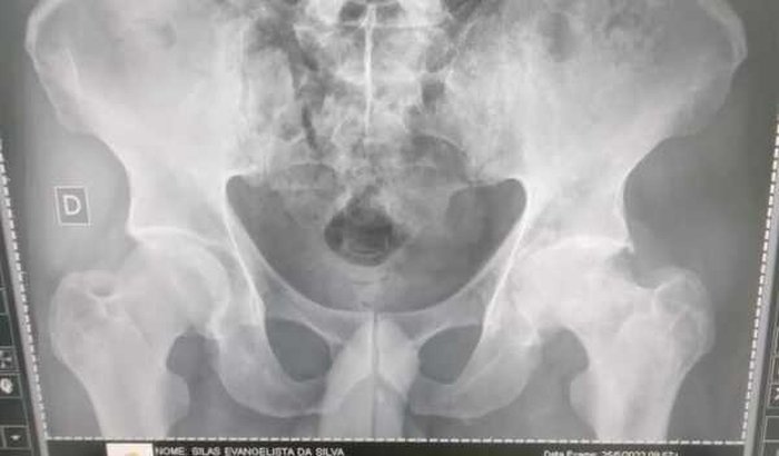 Ajuda para cirurgia de quadril do meu pai