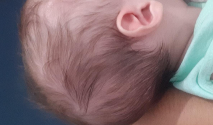 Ajude o pequeno Enzo a fazer a Cirurgia de Craniocinostose