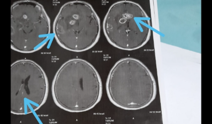 Ajude a Neves de Fátima fazer a cirurgia cerebral com urgência 