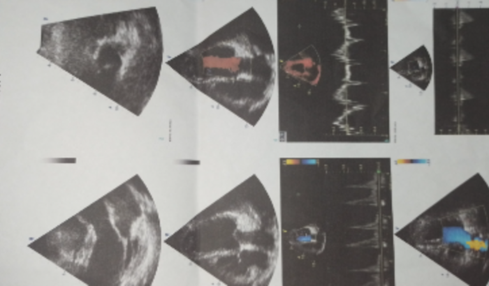 Tratamento para o lupus, e consulta cardiologista