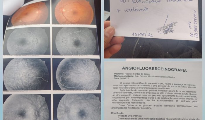 Cirurgia de Catarata+ tratamento de retinopatia diabetica