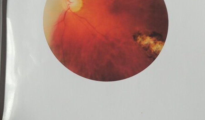 Preciso fazer uma cirurgia urgente na retina