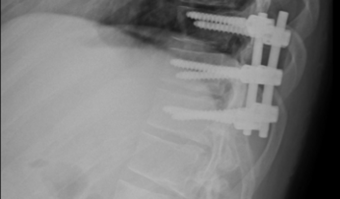 Ajuda tratamento coluna Michel Ferraro