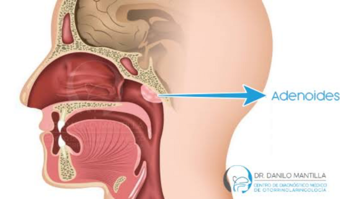 Ajuda para cirurgia de retirada de carne esponjosa (adenoide)