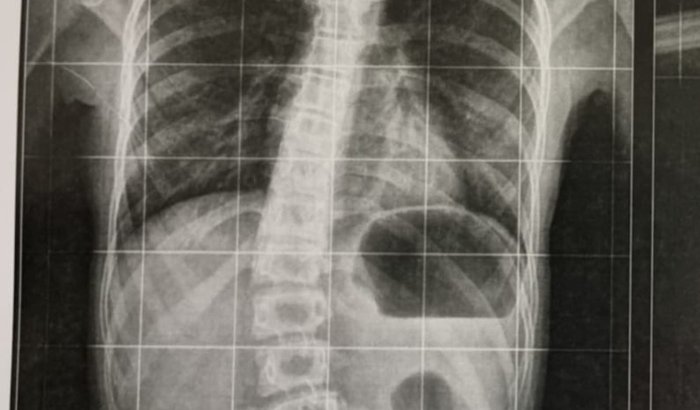 Ajude a Gabriela a Vencer a Siringomielia, Doença Degenerativa.