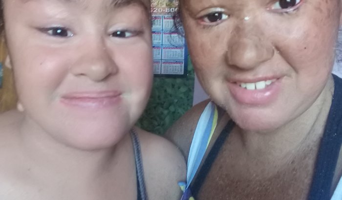 Ajuda para comprar Acitretina para 2 irmã