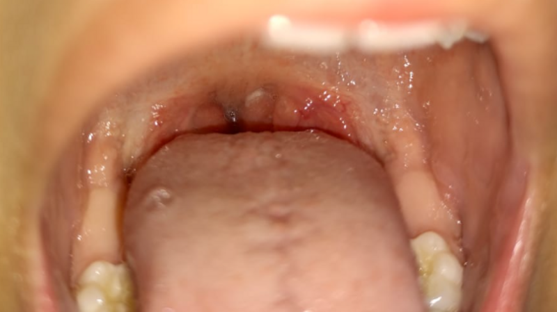 Ajuda para cirurgia de adenoide (carne esponjosa) para Helena