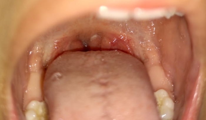 Ajuda para cirurgia de adenoide (carne esponjosa) para Helena