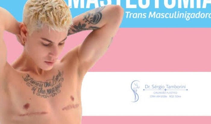 Mastectomia masculinizadora para Michell