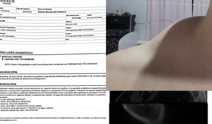 Cirurgia para retirada de tumor (fibromatose tipo desmoide)